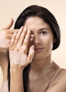 portrait beautiful woman with vitiligo